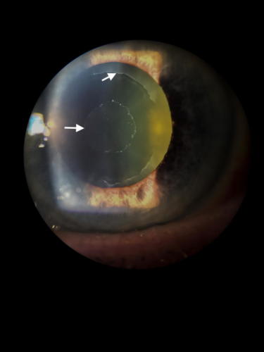 PEX syndrom